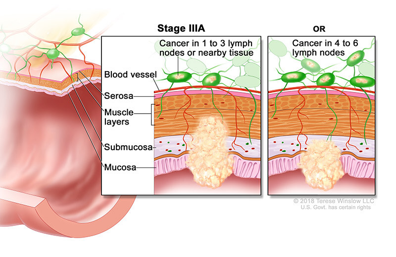 Colorectal Cancer Stages Willamette Valley Cancer Institute Colorectal Cancer Stages Willamette Valley Cancer Institute